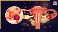 Sanitary Pads Ovarian Cancer
