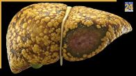 Liver Cirrhosis Symptoms