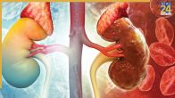 Kidney Disease