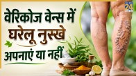 varicose veinse home remedies