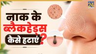 How To Remove Blackheads