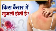 khujli In Cancer