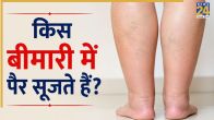 legs swelling