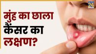 Oral Cancer Symptoms In Hindi: