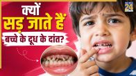 Milk Tooth Cavity Causes