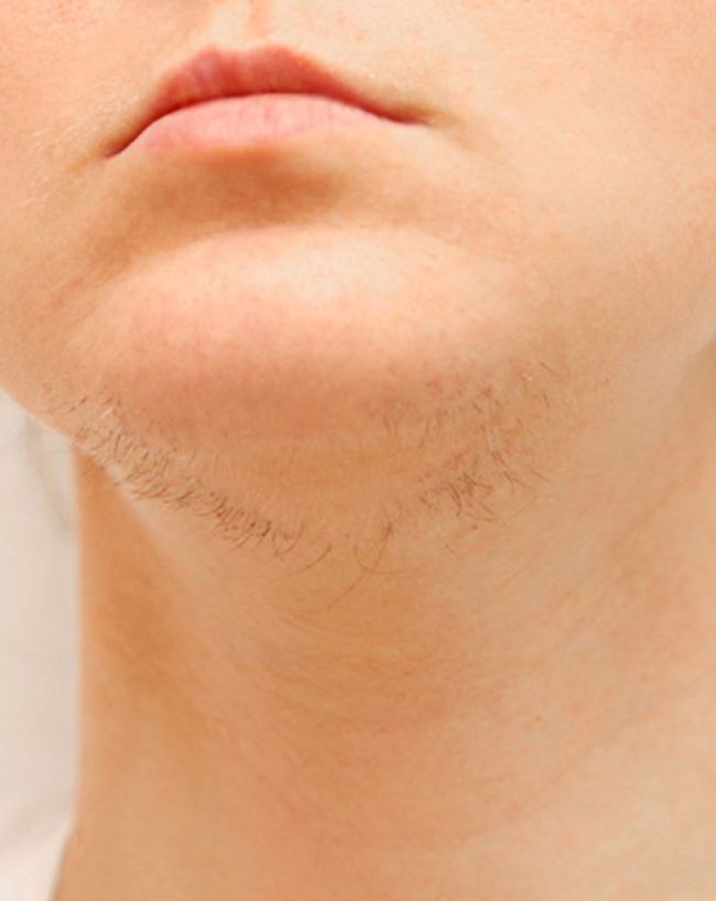 क्यों बढ़ने लगते हैं चेहरे पर बाल?
