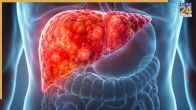 Liver Swelling Symptoms