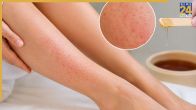 Causes Of Pimple After Waxing