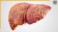 fatty liver symptoms
