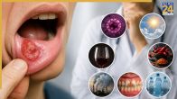 Why Does Tobacco Cause Oral Cancer