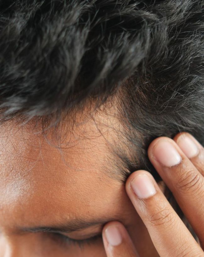 ऑयली स्कैल्प 