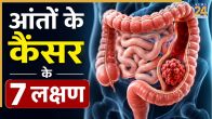 Colon Cancer Symptoms