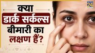Dark Circles Signs