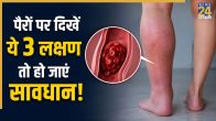 Blood Clots In Legs