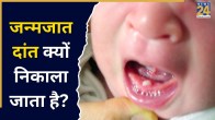 Natal Teeth Extraction