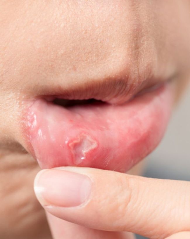 मसूड़ों की सूजन कम करने में मददगार होना  