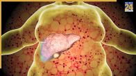 Fatty Liver Disease