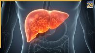Fatty Liver Healthy Foods