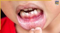 Gum Cancer Symptoms