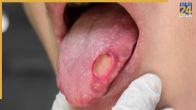 Mouth Cancer Signs