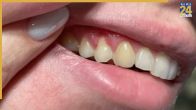 What Age Do Adults Start Losing Teeth: